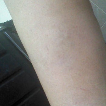 Schulman Vein and Laser Center - And after!!...Thank you Dr. Schulman..... - Medical Spas Near Me - Commack, New York Schulman Vein and Laser Center - And after!!...Thank you Dr. Schulman..... - Medical Spas Near Me - Commack, New York