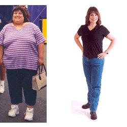 Ara Keshishian, MD FACS FASMBS - Lisa's before and after revision from another weight loss surgery to Duodenal Switch