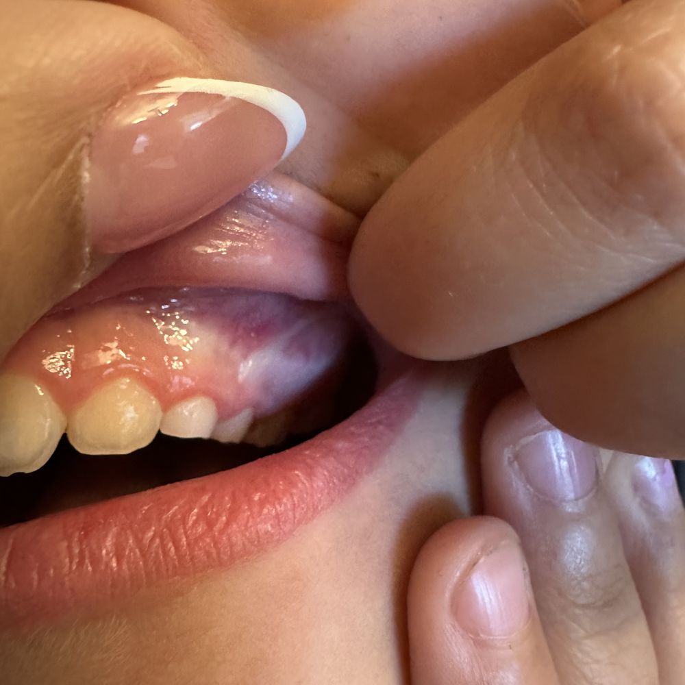 Gold Coast Dental Riverside - Third abscess forming - Orthodontists Near Me - Riverside, California