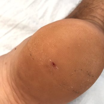 Poipu Mobile MD Clinic - Thorn in foot - Urgent Care Near Me - Lihue, Hawaii
