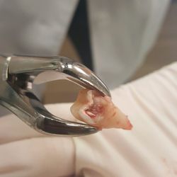 Aces Dental - The decayed wisdom tooth Dr. Aquino expertly pulled.