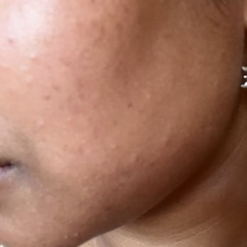 Solutions Skin Care By Kimberly - After - Skin Care Near Me - Costa Mesa, California