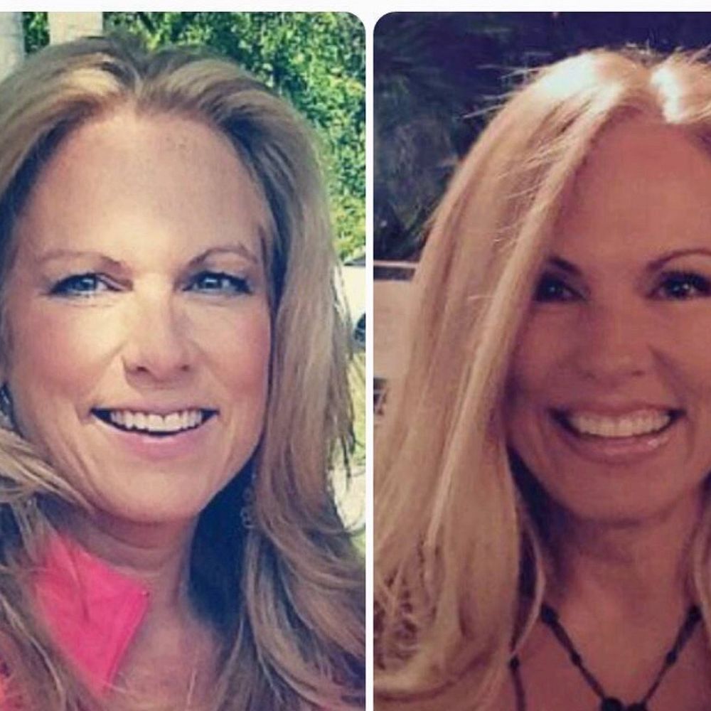 John Martin, MD - Before and after. I'm 50 in this picture. - Cosmetic Surgeons Near Me - Coral Gables, Florida John Martin, MD - Before and after. I'm 50 in this picture. - Cosmetic Surgeons Near Me - Coral Gables, Florida