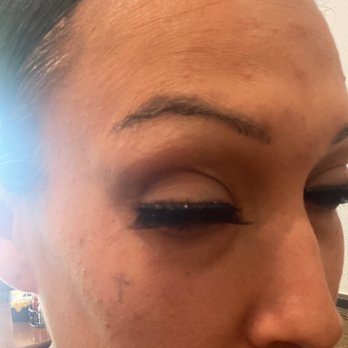 Sani Aesthetics, MD - Forehead and eyes 50 units - Medical Spas Near Me - San Jose, California Sani Aesthetics, MD - Forehead and eyes 50 units - Medical Spas Near Me - San Jose, California