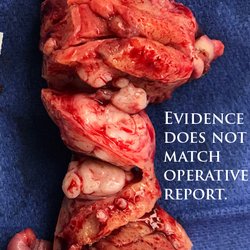 City of Hope Mission Hills - Dr.Lin lied.Photos from surgery doesnt match 2 reports.When morcellated the abnormal/cancerous cells spreads to the portal venous system.