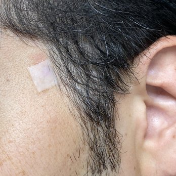 Boardroom Salon for Men - Allen - 2 months of wearing scar patches - Barbers Near Me - Allen, Texas