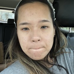 Synergy Day Spa - After treatment one weekq