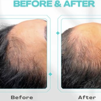 Dina Aesthetics - Acne Treatment Near Me - Dearborn Heights, Michigan Dina Aesthetics - Acne Treatment Near Me - Dearborn Heights, Michigan