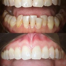 Before/after