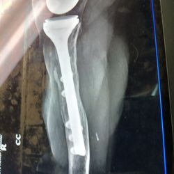 Advanced Orthopedics - After he did my surgery for the long stem reverse they had to send me to a trauma center hospital where I had to have all this metal put in