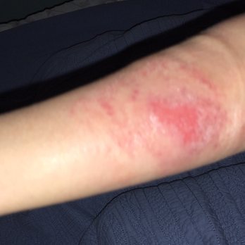 T-Mobile - #TMOBIlE very unreliable can't receive my doctor's call for Allergy & 1st&2nd degree burn - Mobile Phones Near Me - San Jose, California