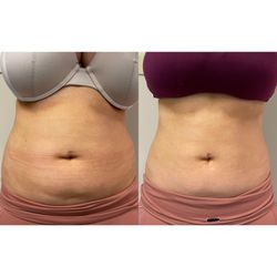 Athena Beauty - 3-4 sessions
