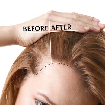 Heavenly Brows & Permanent Cosmetics Academy - Scalp Micro-pigmentation example. - Permanent Makeup Near Me - Winter Park, Florida Heavenly Brows & Permanent Cosmetics Academy - Scalp Micro-pigmentation example. - Permanent Makeup Near Me - Winter Park, Florida