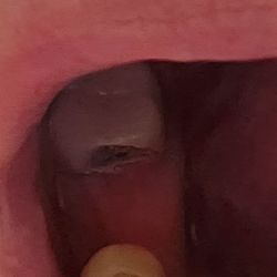Bright Now Dental & Orthodontics - This is a picture of part of my broken bridge that stayed in my mouth and clearly was made with metal.