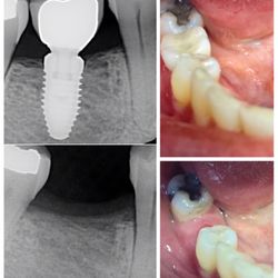 Before and after pictures of a patient who got an implant placement on tooth #29