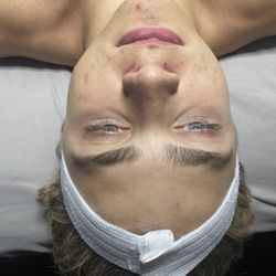 The Well Spa - After using skin care regimen and monthly visits for facials and peels