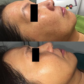Freya Medispa & Wellness - Pigmentation & collagen treatment before & after - Medical Spas Near Me - Calgary, Alberta Freya Medispa & Wellness - Pigmentation & collagen treatment before & after - Medical Spas Near Me - Calgary, Alberta