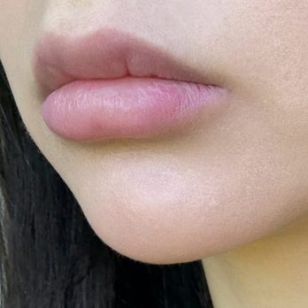 Plump Medspa - Indents/scars from dissolver - Medical Spas Near Me - Beaverton, Oregon