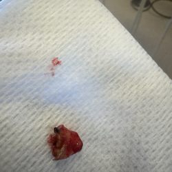 The Foundry Dental Center - Infected tooth