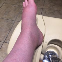 Restoration Foot & Ankle - Injured, swollen foot /ankle