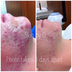 Skin By D - Inflamed cystic acne-3 days between pics