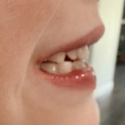 Paulson Orthodontics - What's left of the overbite after just 15 weeks of treatment