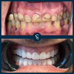 ProSmile Dental Implant Center - Cosmetic Dentistry and Porcelain Veneer Before and After. Phoenix  and Scottsdale's Top Cosmetic Dentistry for Veneers and Crowns