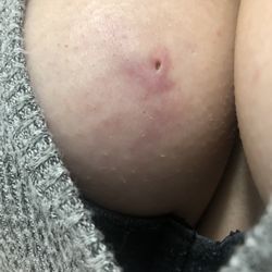 Lomis Thomas MD - Final results 11 months after seeing dr Lomis