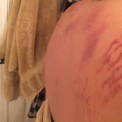 Worst mistake ever of my life. This is what one of the masseuse did to me.