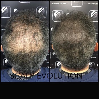Scalp Evolution - Hair Loss Centers Near Me - Miami, Florida
