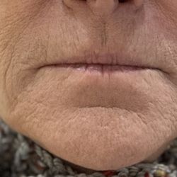 Artisan Beaute' - BEFORE Caroline's artistry with fillers