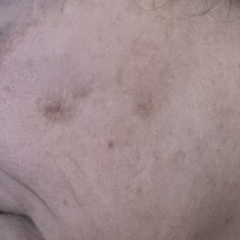 LightRx - Charlotte - After treatment (left) - Skin Care Near Me - Charlotte, North Carolina LightRx - Charlotte - After treatment (left) - Skin Care Near Me - Charlotte, North Carolina