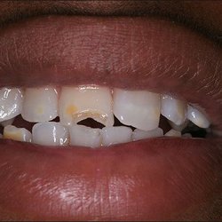 Smiles Art Dentistry - Filling (Before restoration)
