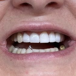 Richmond Dental Care - The entire top row was made by one doctor with one hand. 12 crowns, all different colors, sizes, shapes. The crowns have jagged sharp edges