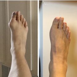 Robert Vallone, DPM - Left side before surgery. Right side 10 weeks post op. Big bump gone!