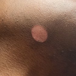 Burn under the chin 1st time. This is the burn literally right after treatment 1st day.
