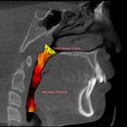 Dental & Beyond - The patient played tennis but was limited by fatigue prior to orthodontic treatment.
After correction she was able to last longer!