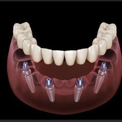 Lifetime Smiles - Smile with confident! Secure your denture with Implant
