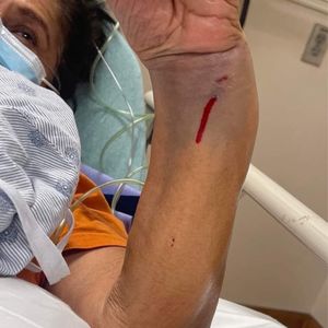 Photo of Ascension Dell Seton Medical Center at The University of Texas - Austin, TX, United States. 76 yr old broken arm