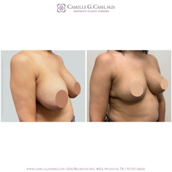 Camille Cash, M.D - Before and After Explantation (Breast Implant Removal), Capsulectomy, and Autoaugmentation Lift