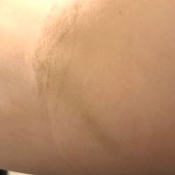 Sugar Land Diagnostic Center - A couple days after-healing.