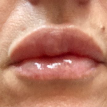 Mayberry Plastic Surgery - 20 Days after bad filler technique - Plastic Surgeons Near Me - Albuquerque, New Mexico