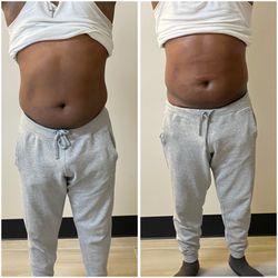 REFINE Non-Invasive Aesthetic & Wellness Center  - Cryo sculpting - One Session