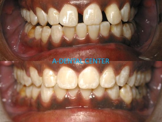 Invisalign Treatment - These are two Orthodontic cases completed with Invisalign Clear Aligners.  Spacing and crowding due to arch deficiencies are some of the most common reasons patients come in for braces. Most orthodontic treatments with Invisalign are completed within 12 months.