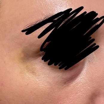 Eye Candy - Bruised eye (2 weeks after) from Botox injections. WOULD NOT RECOMMEND THIS BUSINESS - Eyelash Service Near Me - Lakewood, California