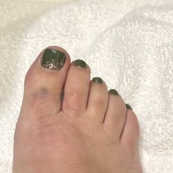Open Canvas Laser Aesthetics - Before tattoo removal