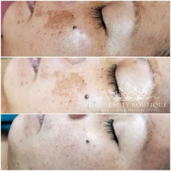 The Beauty Boutique - Melasma 3 months before and after.