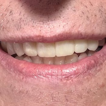 Alberta Dental - After - General Dentistry Near Me - Los Algodones, BCN