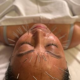 Facial needling