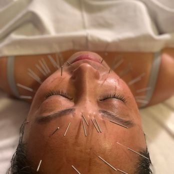 Mai Acupuncture - Facial needling - Acupuncture Near Me - Campbell, California